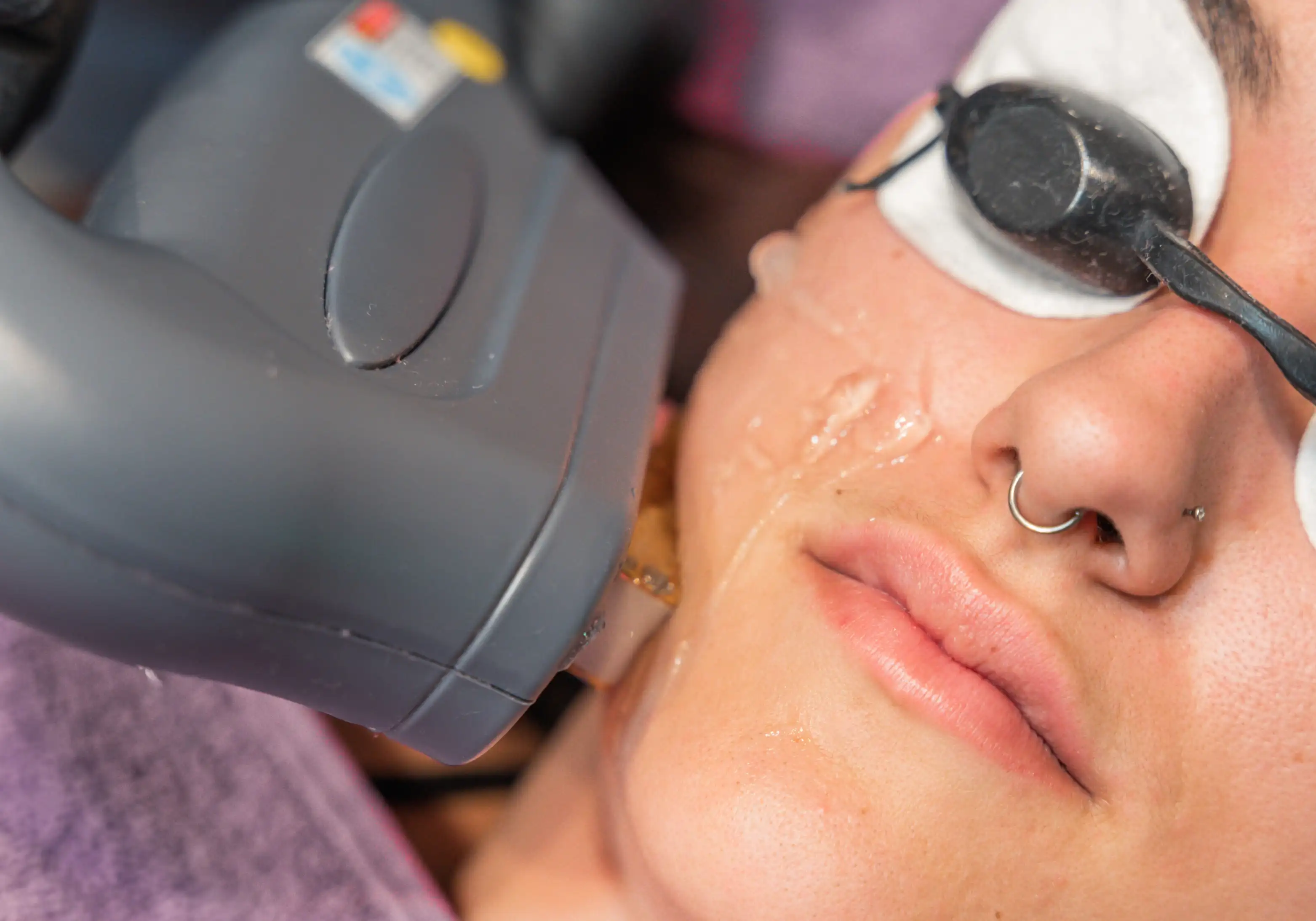 Depilación Láser Facial