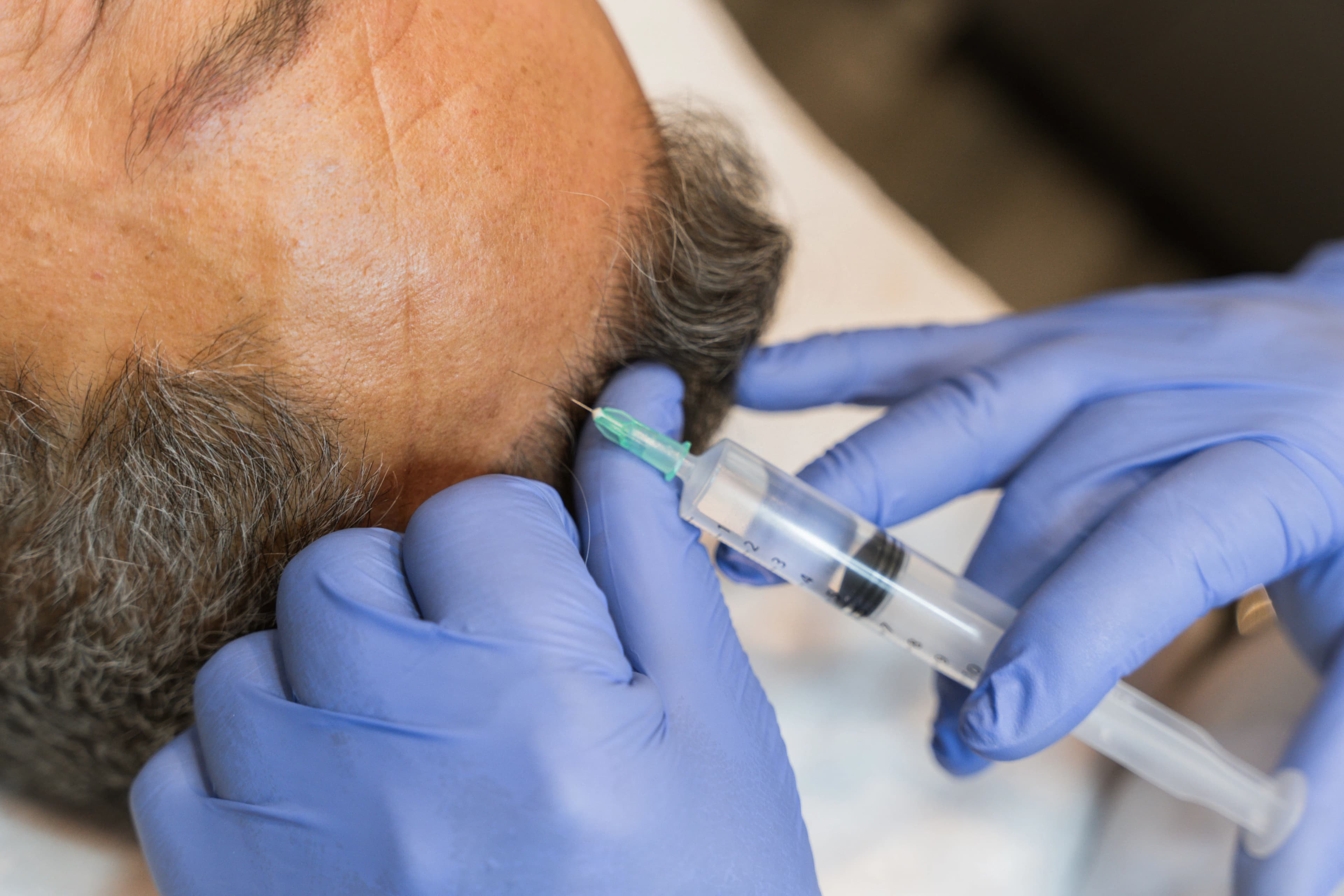 Tratamiento Capilar Factores de Crecimiento